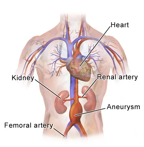 Abdominal Aortic Aneurysm Location. Animation in the reference.[1]