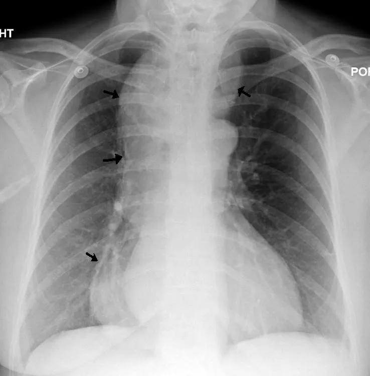 A CXR showing achalasia ( arrows point to the outline of the massively dilated esophagus )