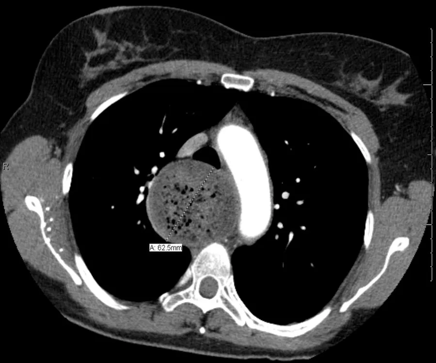 A transverse CT image showing marked dilatation of the esophagus.
