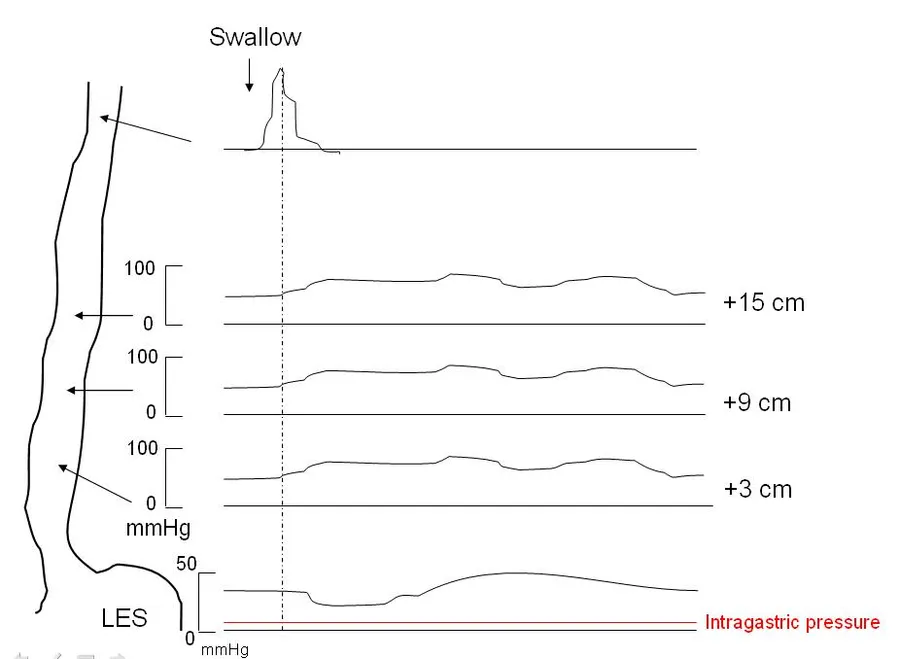 Manometric schematic of achalasia demonstrating aperistaltic contractions, increased intraesophageal pressure and failure of relaxation of the lower esophageal sphincter.