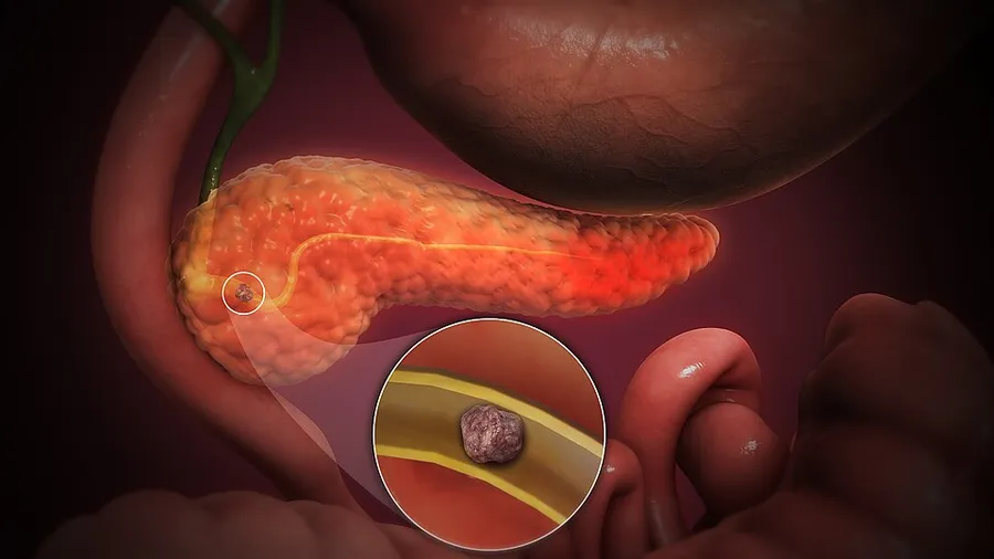 3D Medical Animation still shot of pancreas showing acute pancreatitis