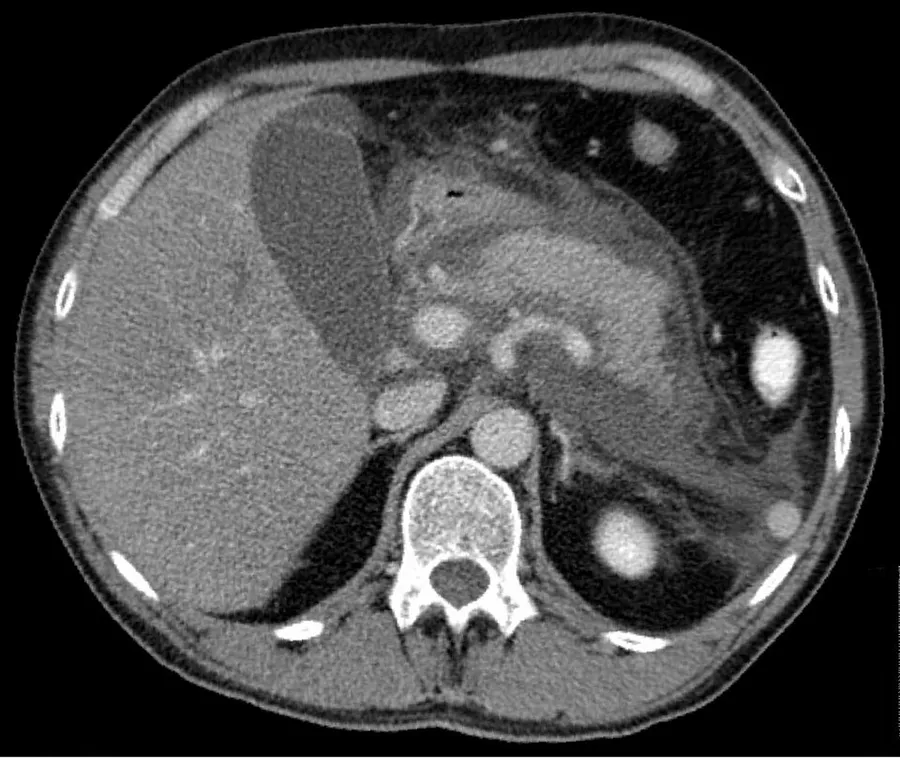 Acute exudative pancreatitis on computed tomography with extensive fluid around the pancreas.
