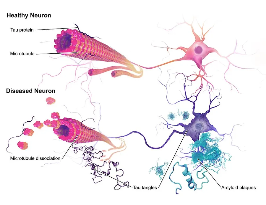 An illustration of the neuropathology of Alzheimer's disease.