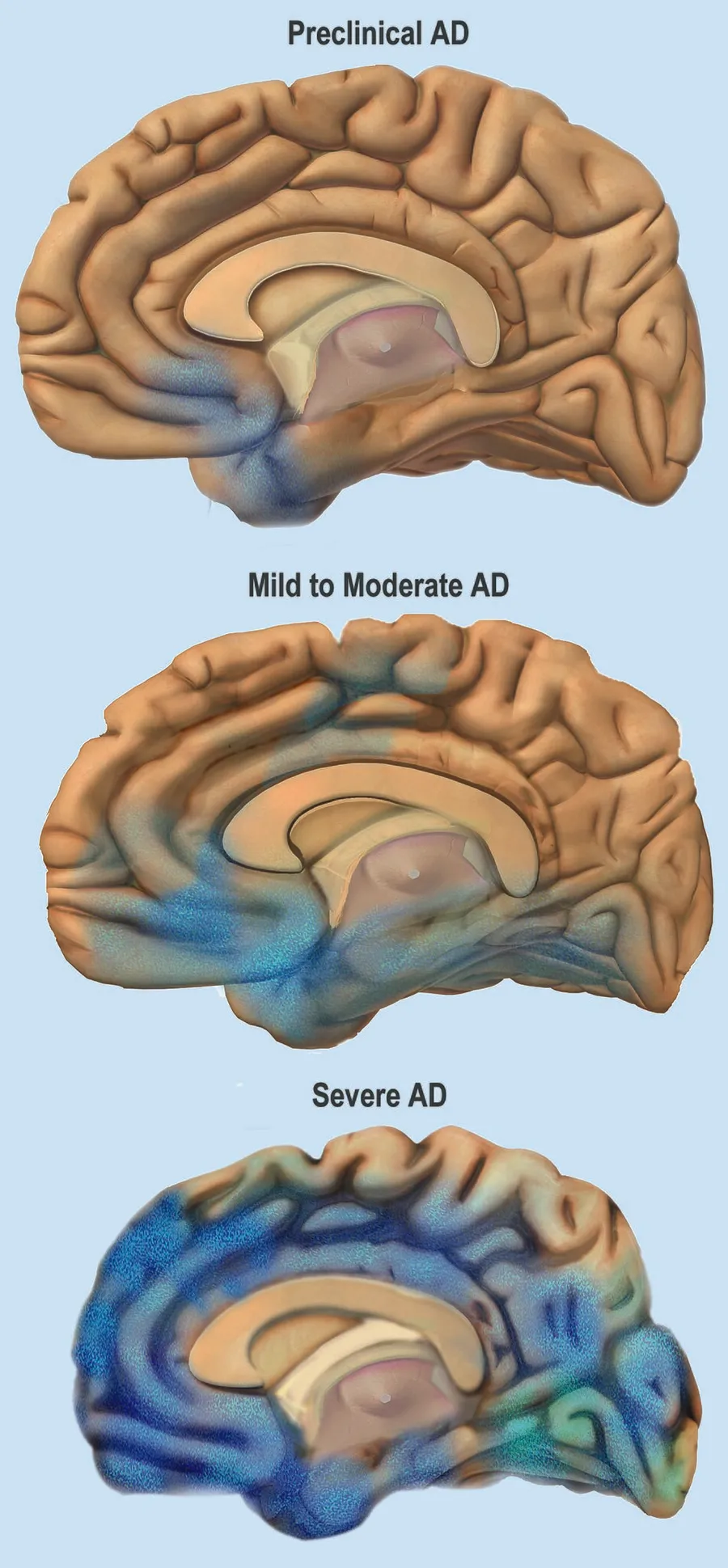 Illustration of how Alzheimer’s Disease spreads through the brain Credit: National Institute on Aging, National Institutes of Health