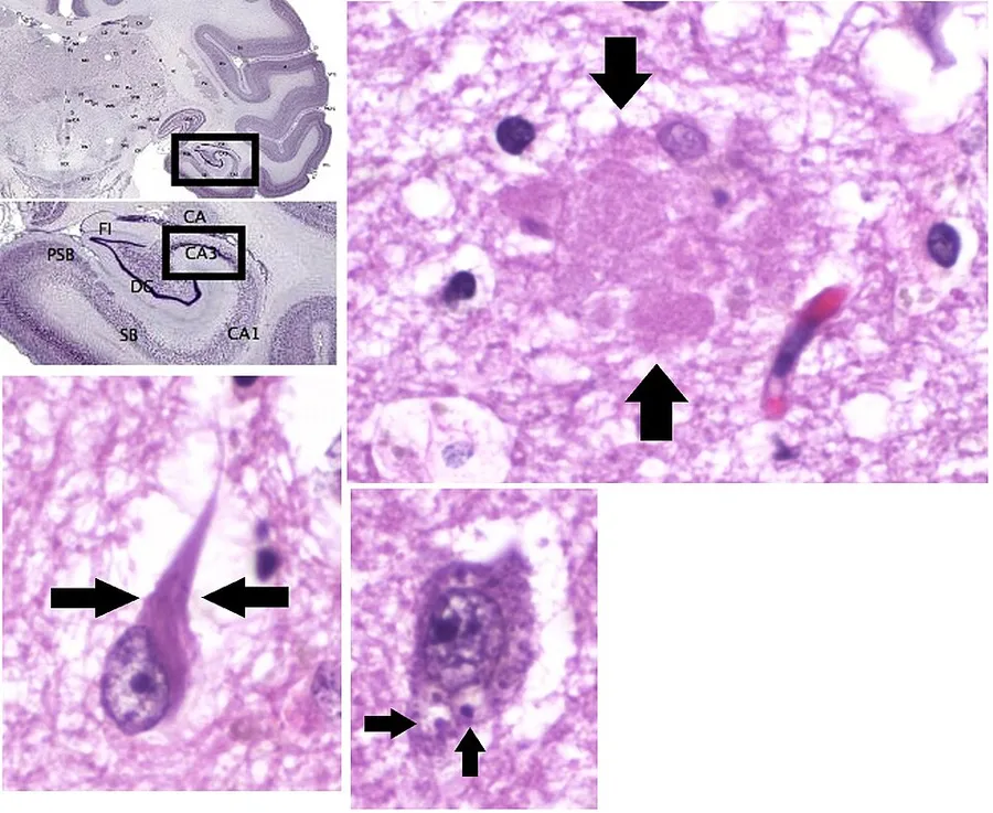 Histopathology of Alzheimer's disease, in the CA3 area of the hippocampus (here showing a normal histology image to describe the location - it is usually atrophied in Alzheimer's disease): Amyloid plaque (top right), neu