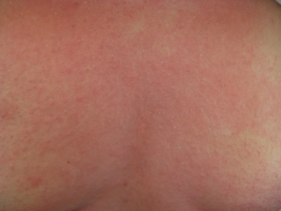 A rash on the chest of a person with anaphylaxis.