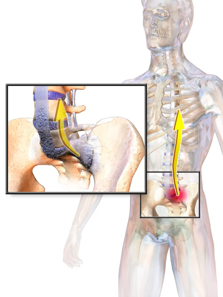 Ankylosing Spondylitis.