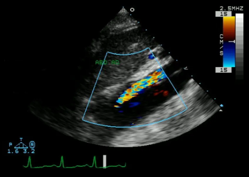 Echocardiogram of aortic dissection - Color