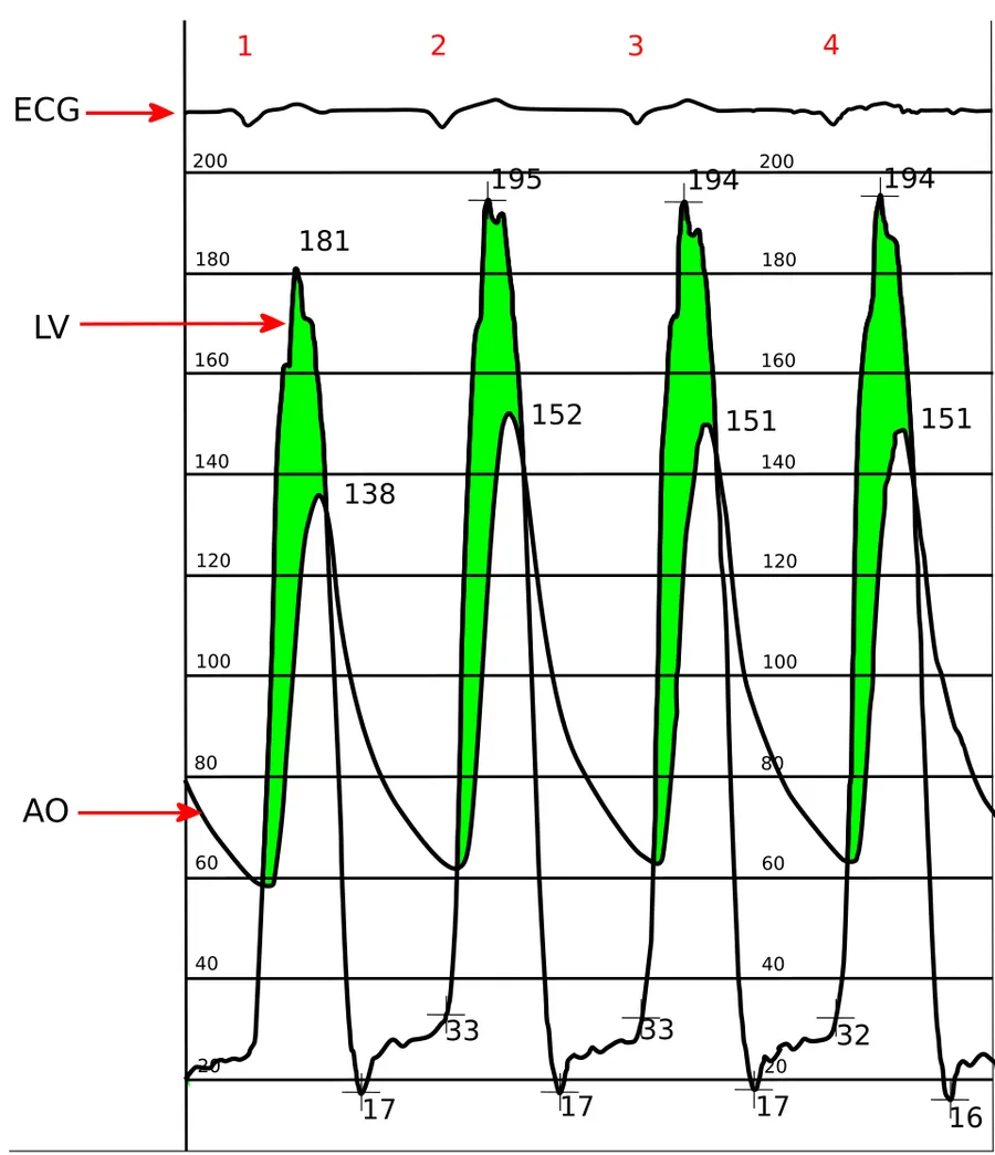Simultaneous left ventricular and aortic pressure tracings, demonstrating a pressure gradient, which is due to aortic stenosis.