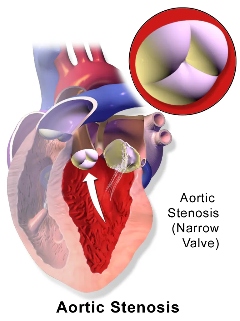 Aortic Stenosis.