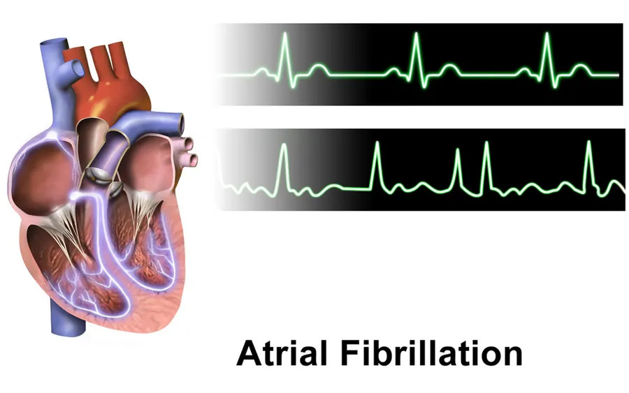 Atrial Fibrillation.