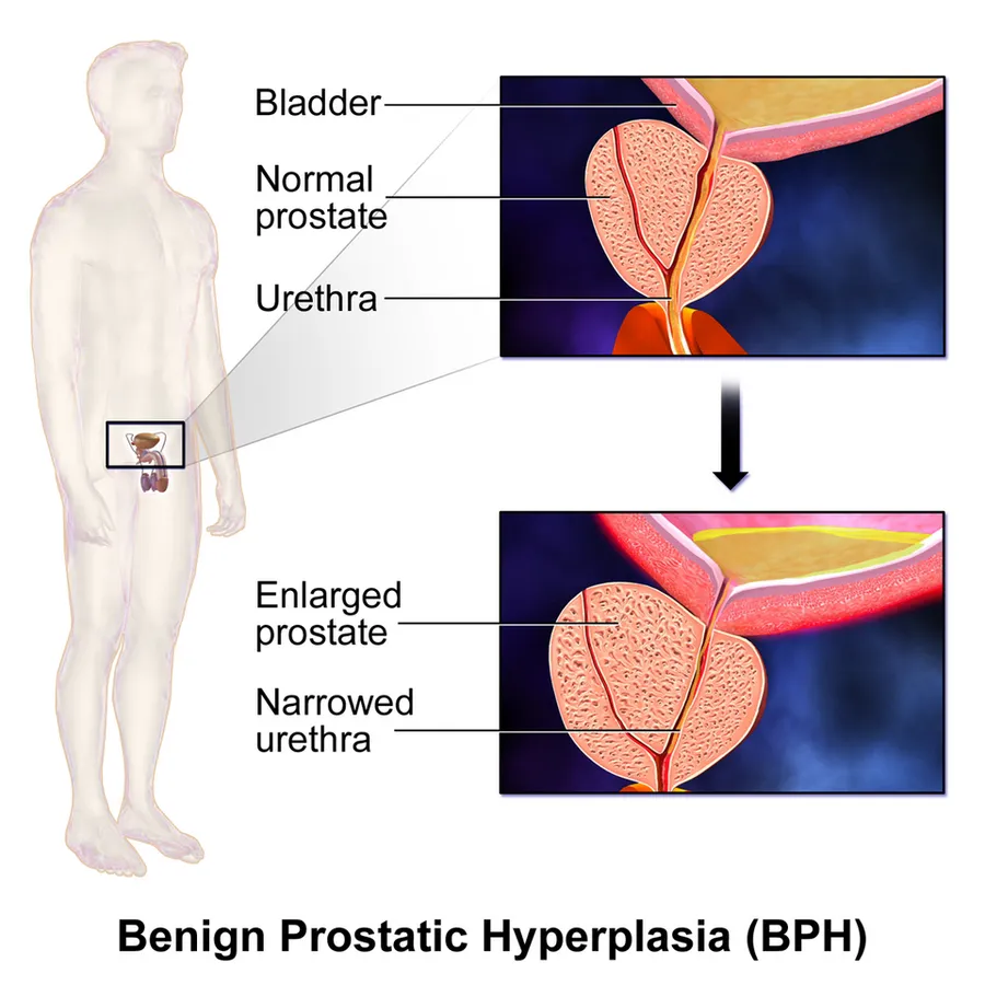 Benign Prostatic Hyperplasia (BPH).