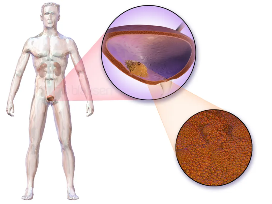 Bladder Cancer.