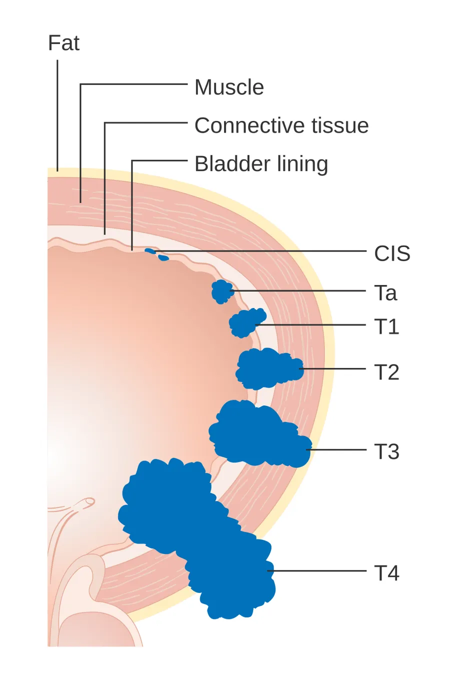 Diagram showing the T stages of bladder cancer.