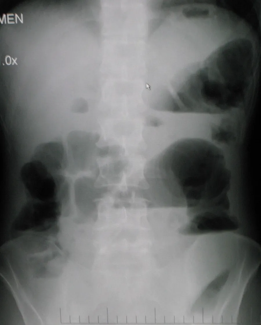 Upright abdominal X-ray demonstrating a bowel obstruction