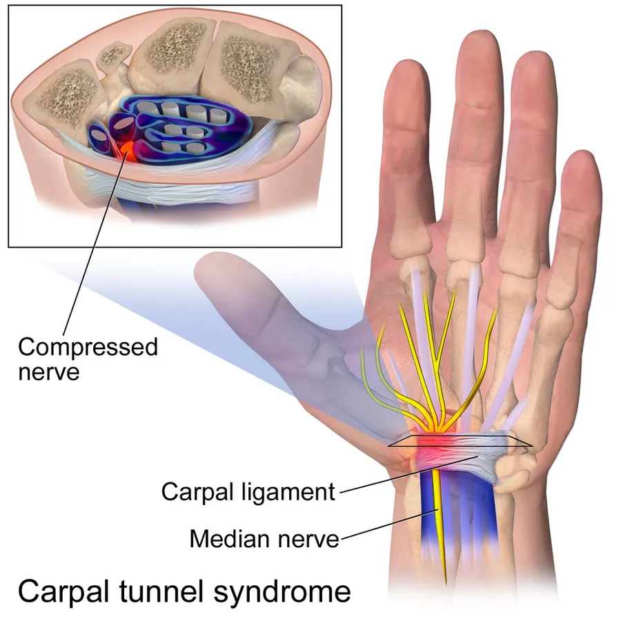 Carpal Tunnel Syndrome.