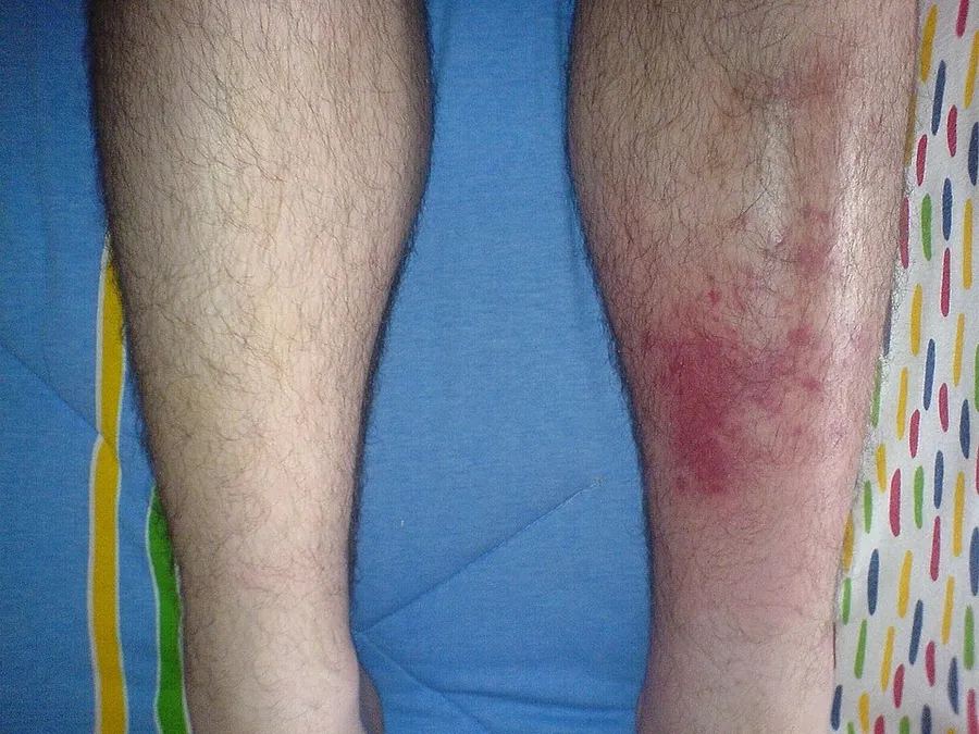 Cellulitis case, left shin infection.