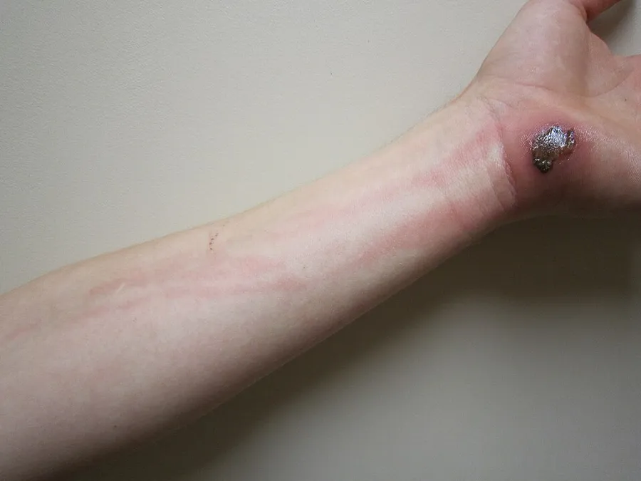 Cellulitis following an abrasion. Note the red streaking up the arm from involvement of the lymphatic system.