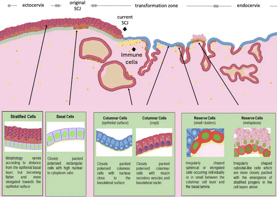 Epithelial cell types of the uterine cervix. Reserve cells occur beneath the columnar epithelium and may proliferate during squamous metaplasia.