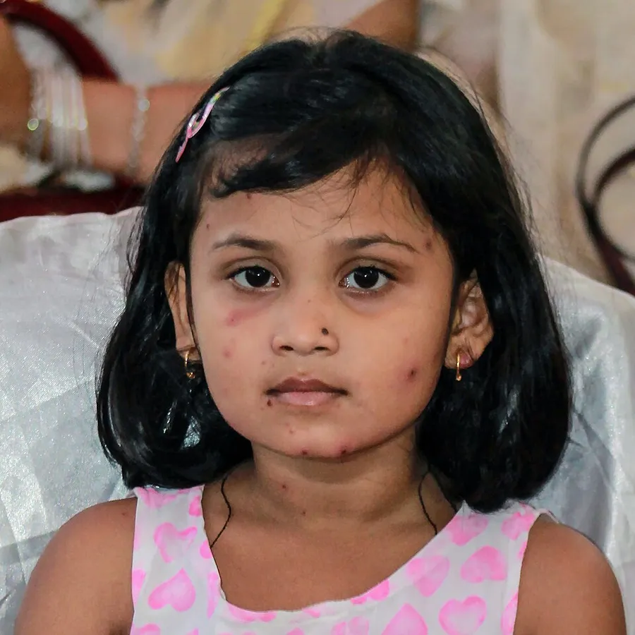A child with chickenpox, Chittagong, Bangladesh
