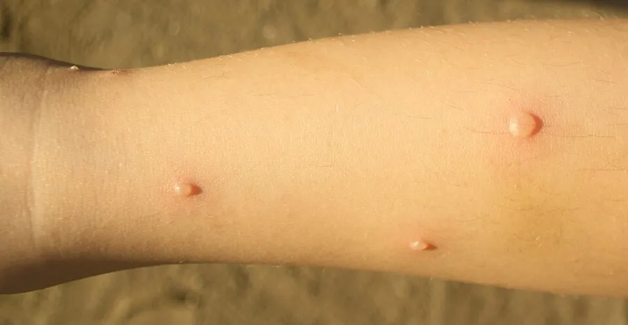Chickenpox blisters on the lower leg of an 8 year old female 4 days after onset of blisters.