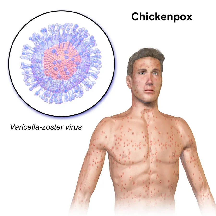 Chickenpox.