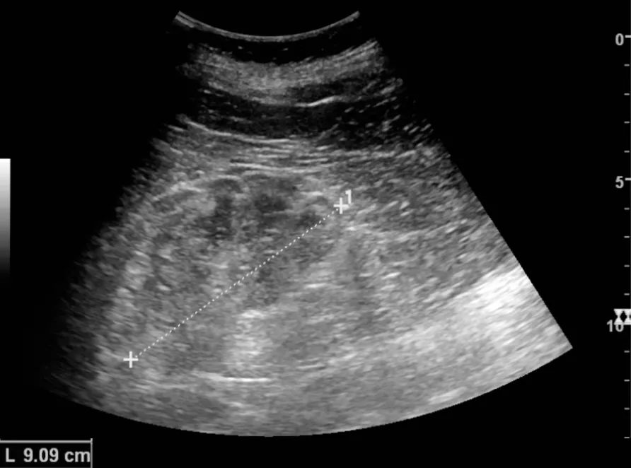 Chronic renal disease caused by glomerulonephritis with increased echogenicity and reduced cortical thickness. Measurement of kidney length on the US image is illustrated by ‘+’ and a dashed line. For context, see en:Ren