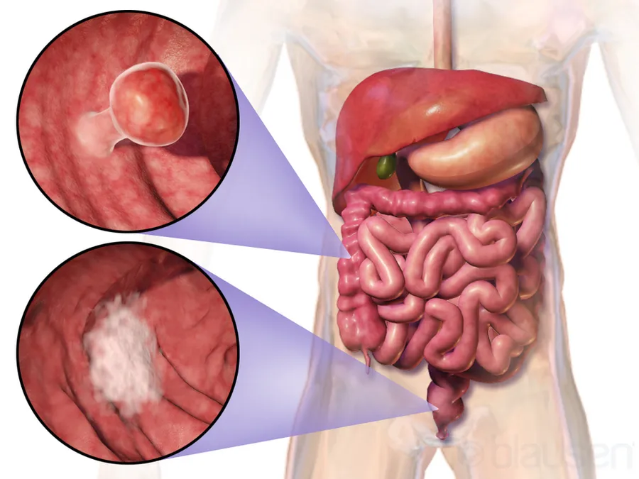 Colorectal Cancer.