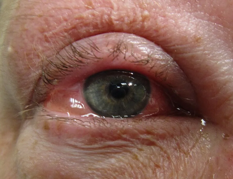 Allergic conjunctivitis showing conjunctival edema