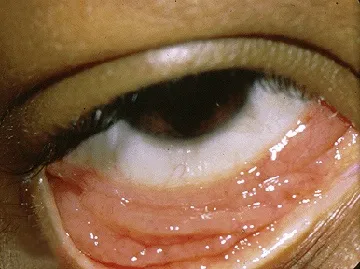 Photograph showing a case of chlamydial conjunctivitis