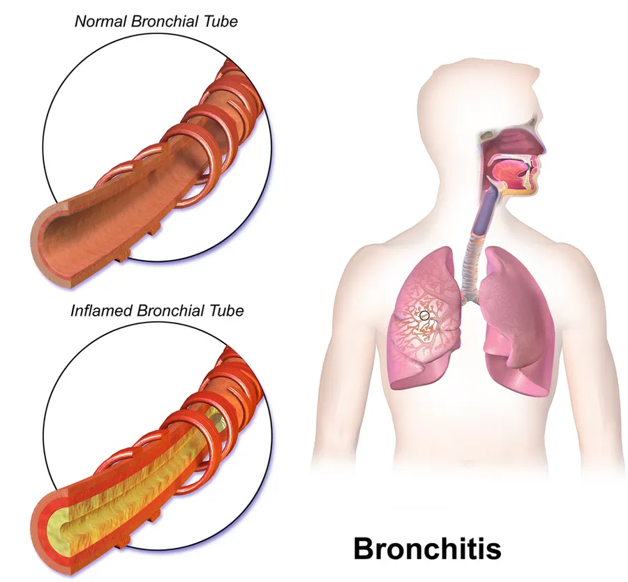 Bronchitis.