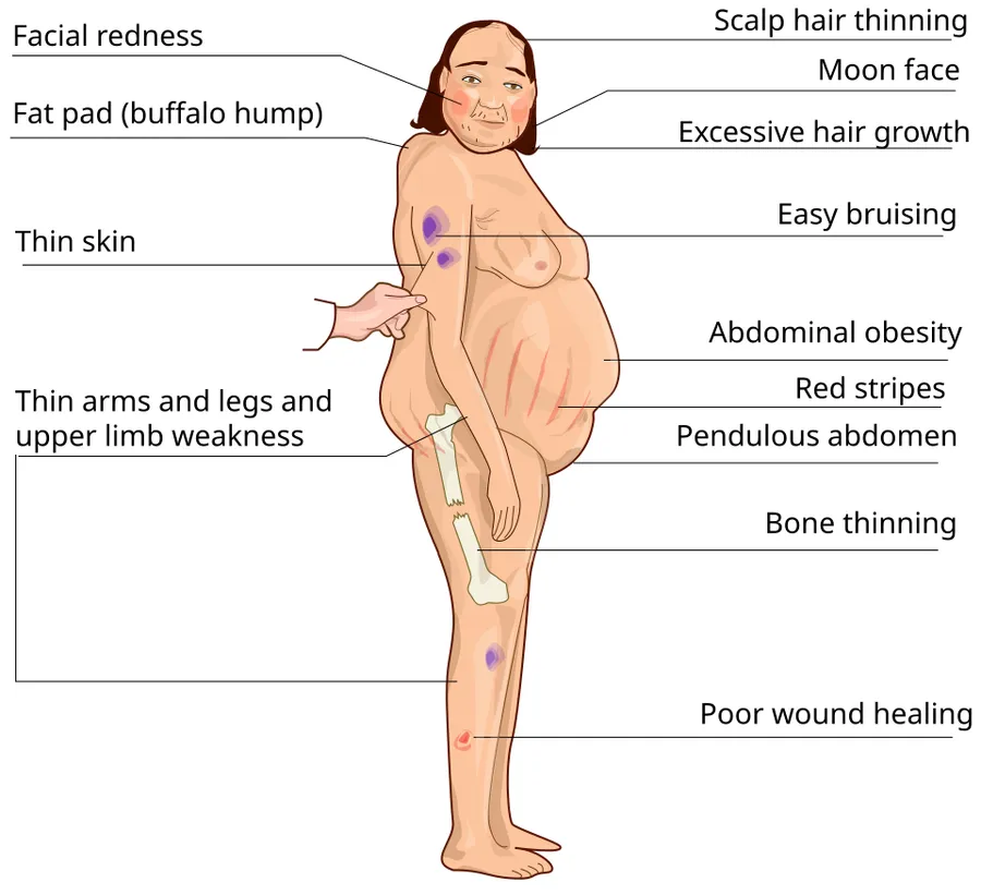 Cushing syndrome symptoms