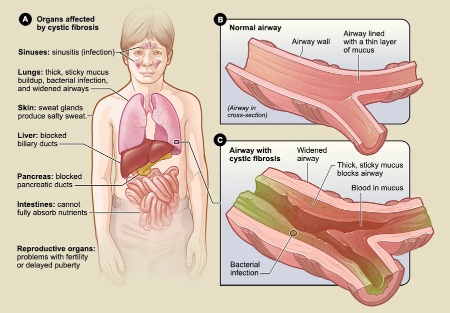 Section A of the illustration shows the organs that may be affected by cystic fibrosis. Section B shows a normal airway with a thin layer of mucus lining the wall. Section C shows an airway with cystic fibrosis. The wide