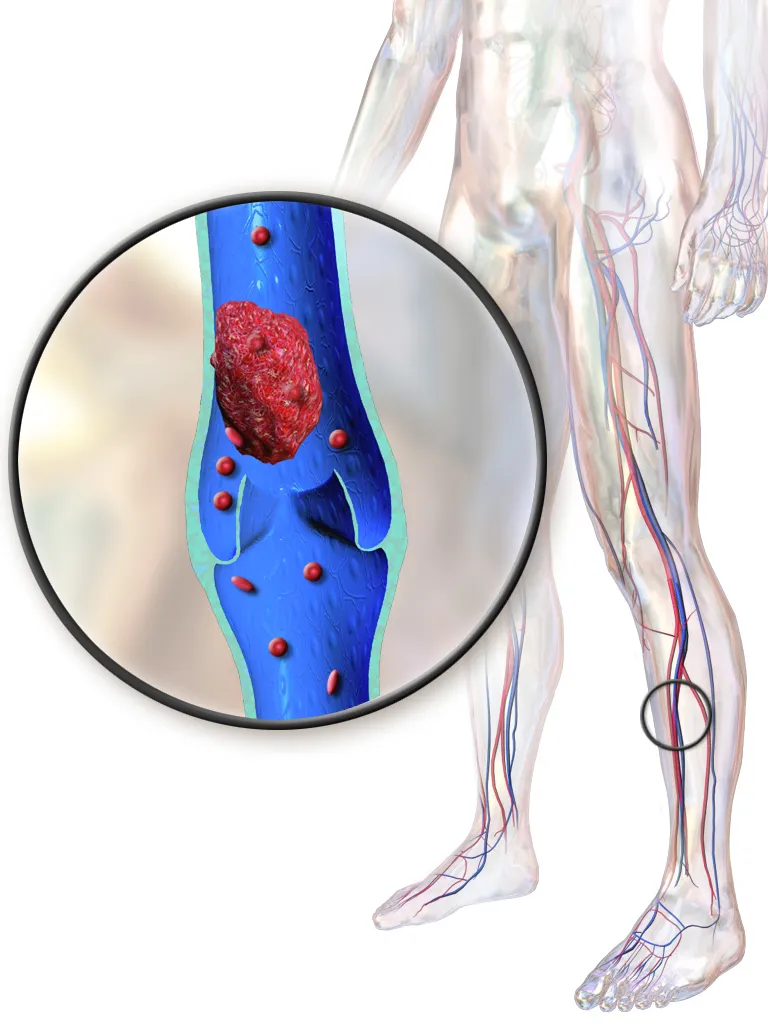Deep Vein Thrombosis.