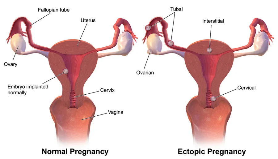 Ectopic Pregnancy.
