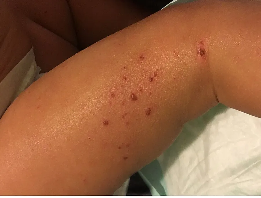 Eczema, or atopic dermatitis, is an inflammatory skin condition that affects an estimated 30 percent of the U.S. population, mostly children and adolescents. This young child is experiencing the dry, itchy skin associate