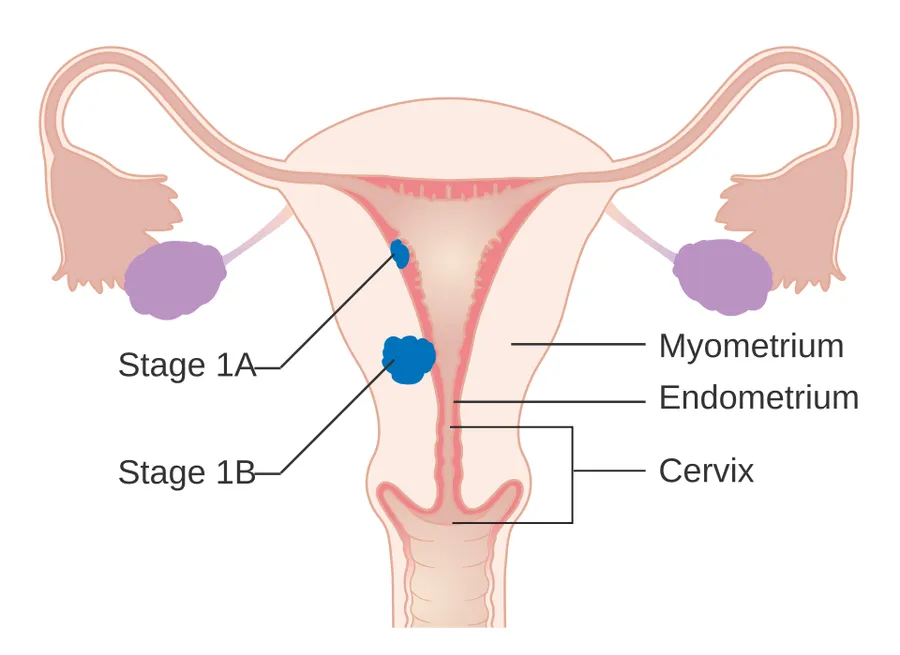 Diagram showing stage 1A and 1B cancer of the womb.