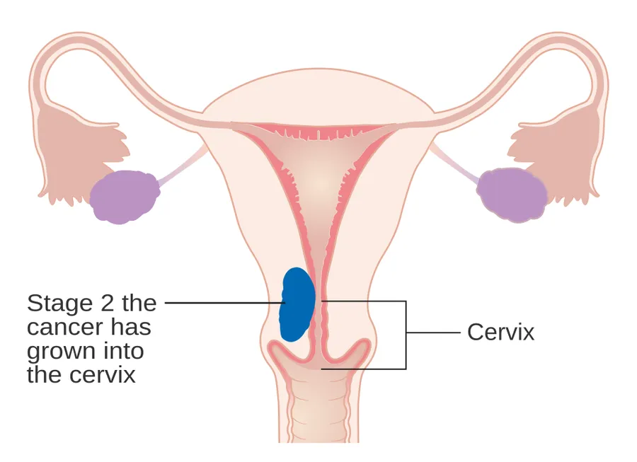 Diagram showing stage 2 cancer of the womb.