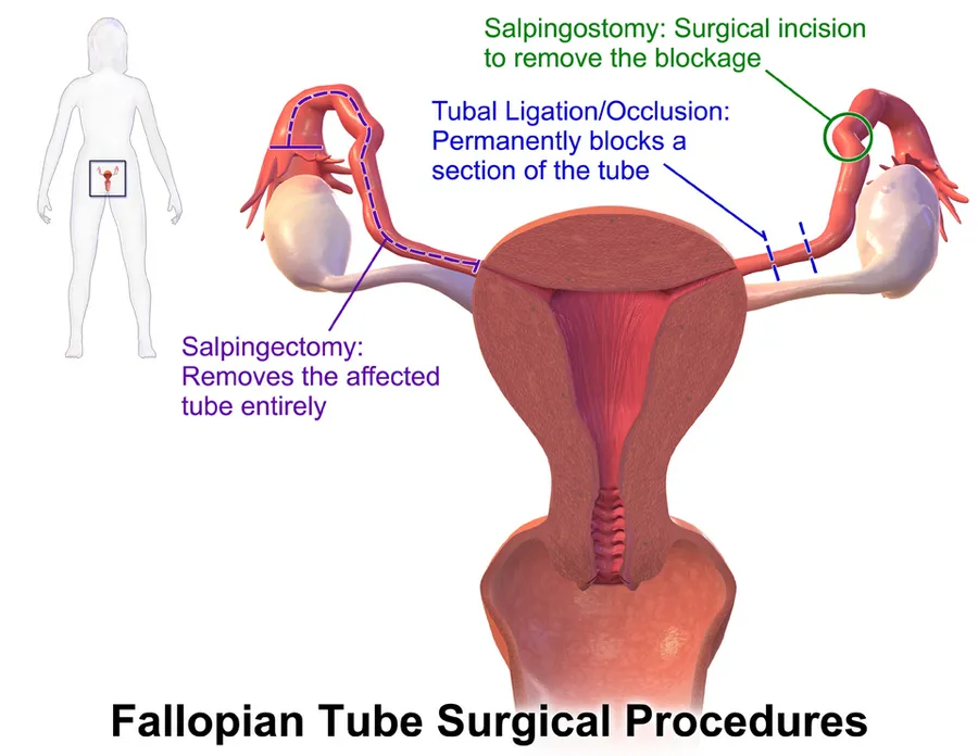 An illustration depicting the different surgical procedures on the Fallopian tube.