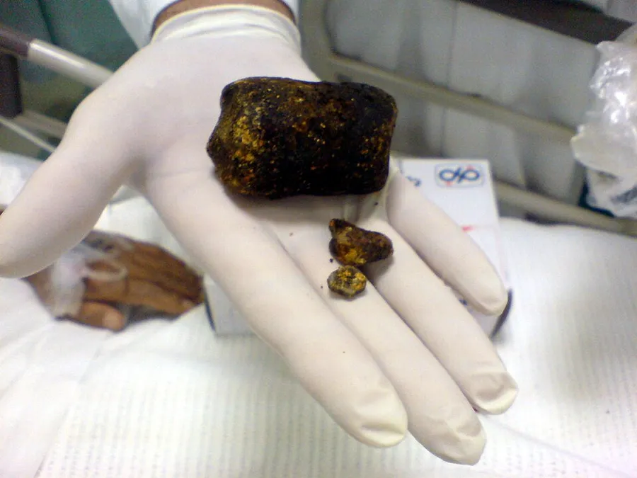 This very large gallstone was removed from patient in King Saud Medical City in Riyadh, Saudi Arabia
