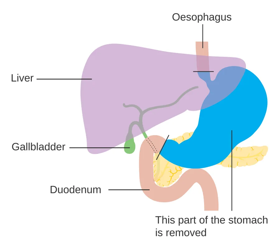 Diagam showing the anatomy before Roux-en-y surgery for stomach cancer.
