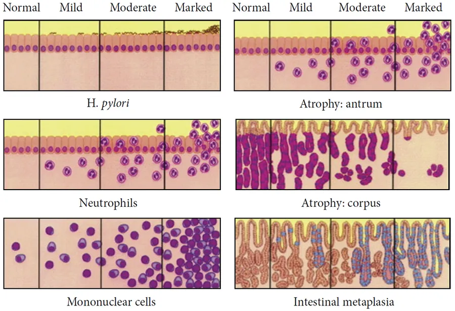 Updated Sydney System for visual classification of gastritis