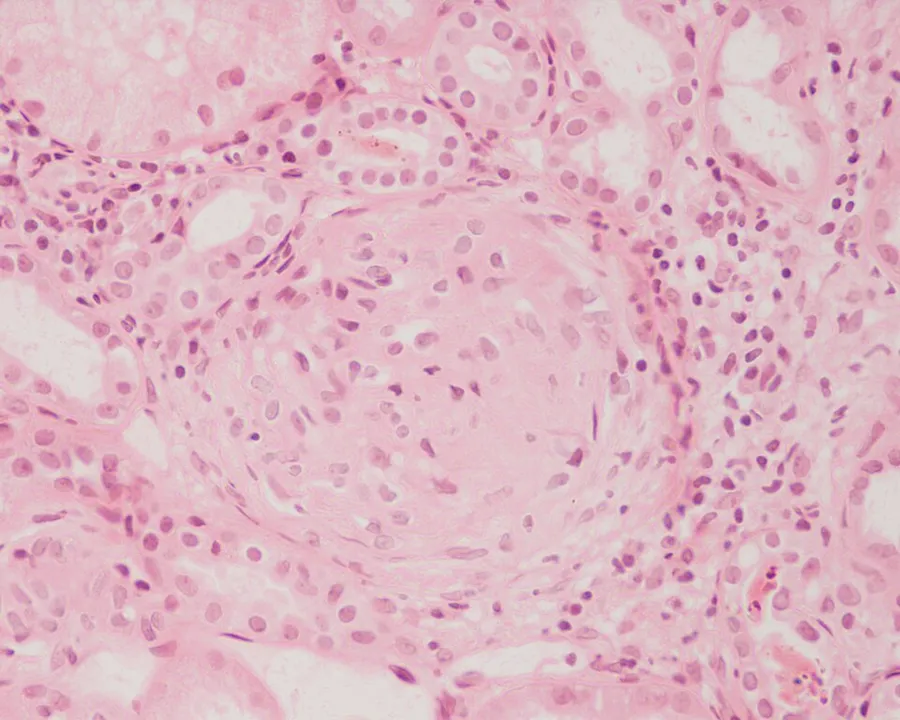 Photomicrograph of the renal biopsy showing prominent fibrocellular crescent formation and moderate mesangial proliferation in a glomerulus. Hematoxylin and eosin stain.