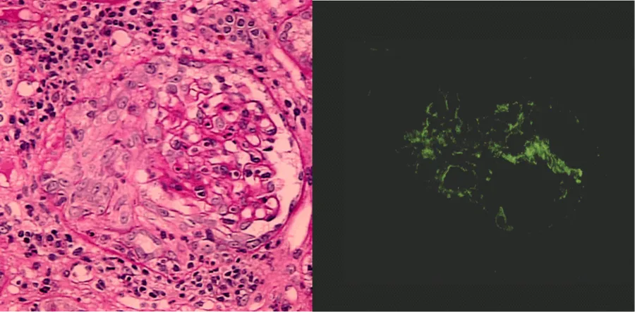 Crescentic glomerulonephritis induced by infective carditis on PAS staining and IF. A. PAS staining demonstrated circumferential and cellular crescent formation with interstitial nephritis. B. IF demonstrated C3 positive
