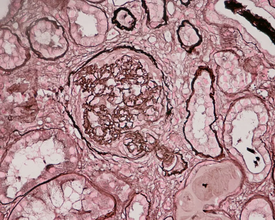 Photomicrograph of renal biopsy showing crescent formation and tuft narrowing. Periodic acid silver methanamine stain.