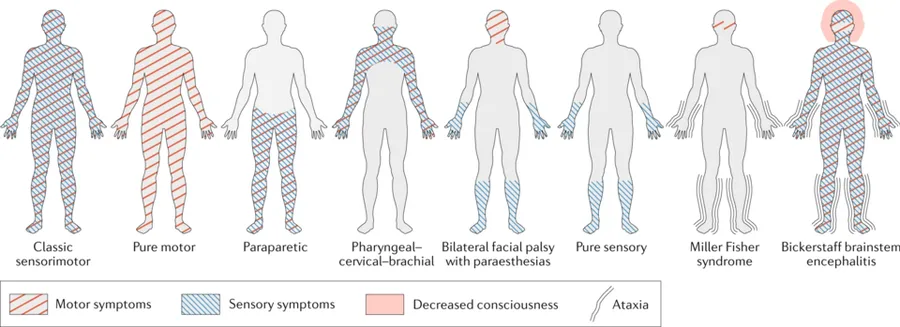 Signs and symptoms of Guillain–Barré syndrome can be purely motor, purely sensory (rare), or a combination of both, affecting the whole body or select regions.