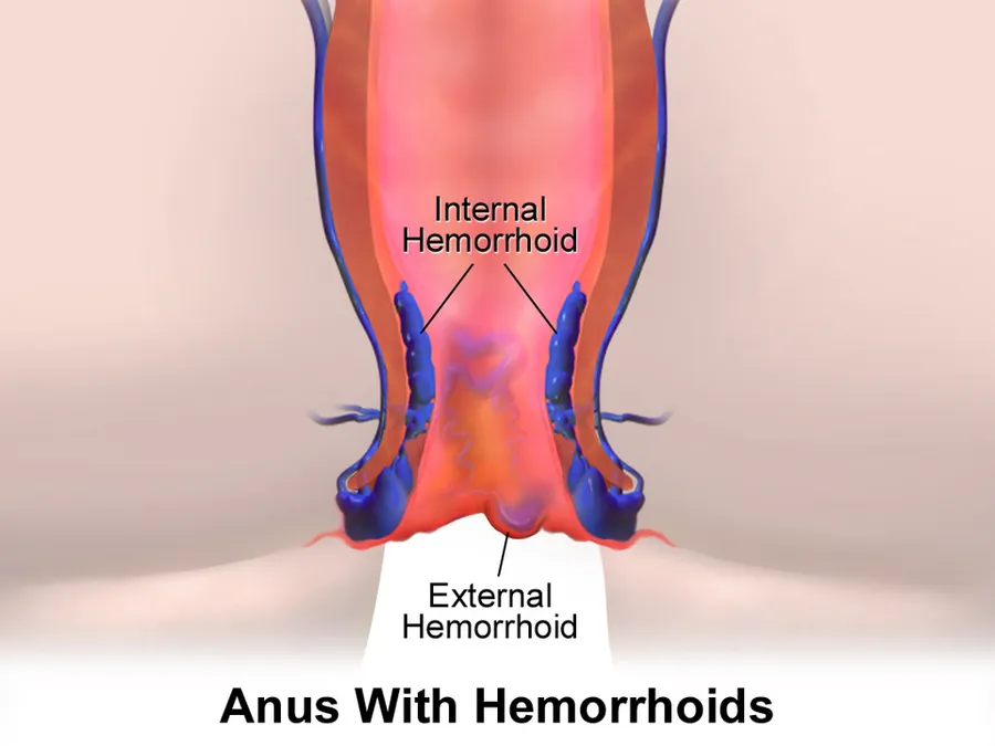 Hemorrhoids.