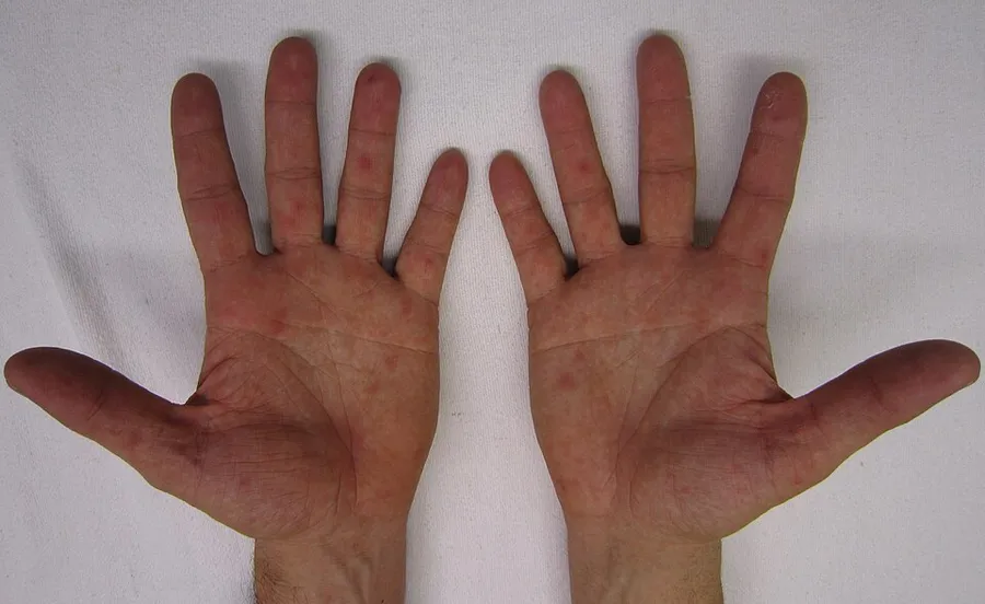 The rash of hands foot and mouth disease.