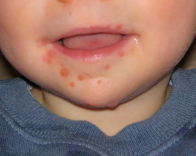 Lesions caused by the Hand, Foot and Mouth Virus on a 11 month old male.