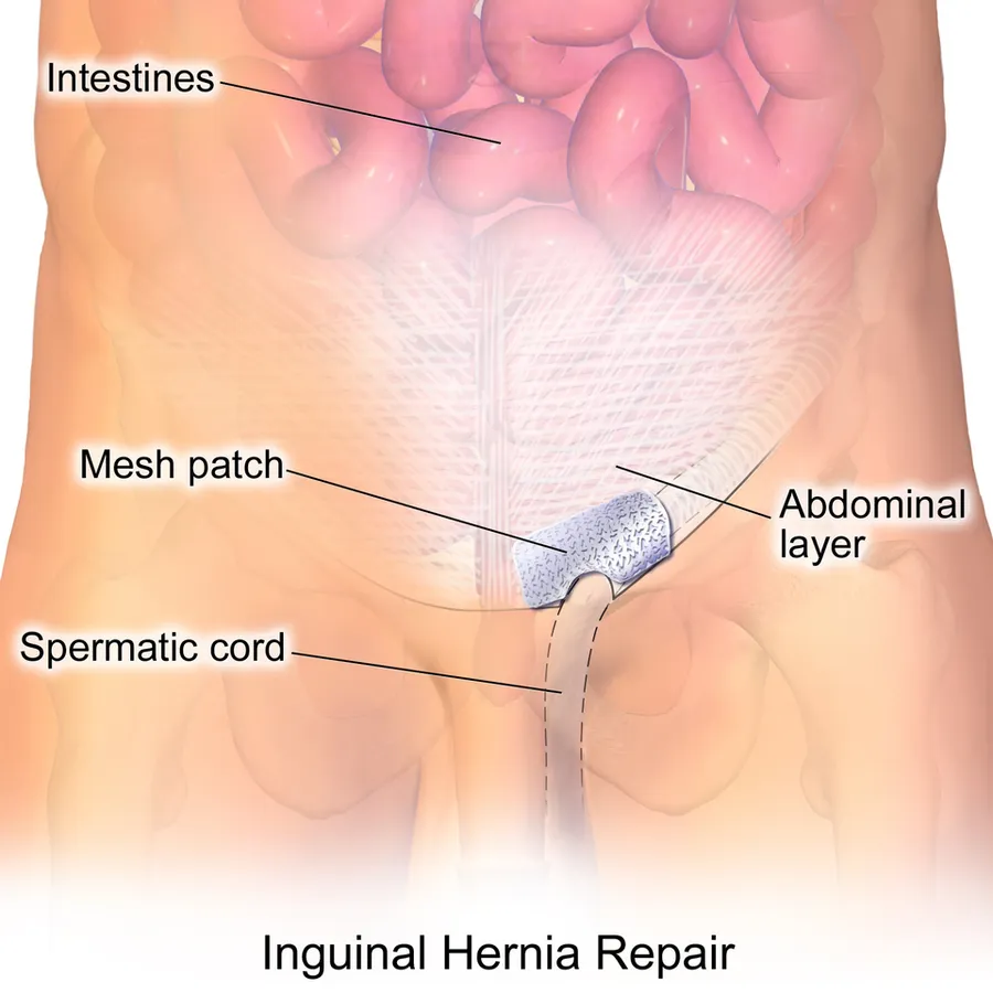 An illustration depicting an inguinal hernia repair.